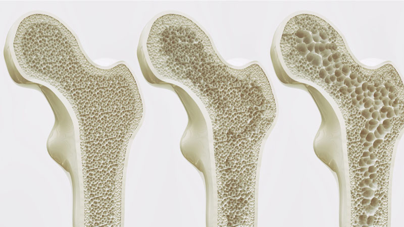 Mengenal Apa Itu Osteoporosis dan Cara Mencegahnya Sejak Muda – PAFI Panaragan Jaya